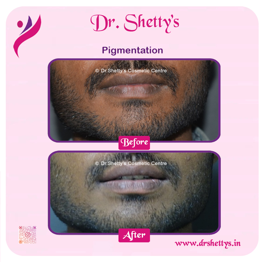 Lip Lightening Treatment 12