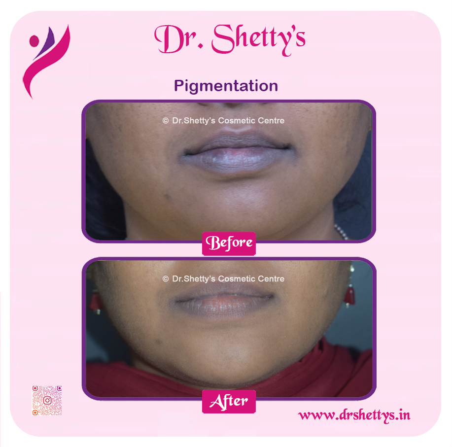 Lip Lightening Treatment 13