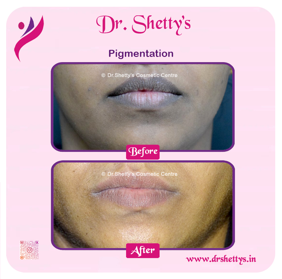 Lip Lightening Treatment 14