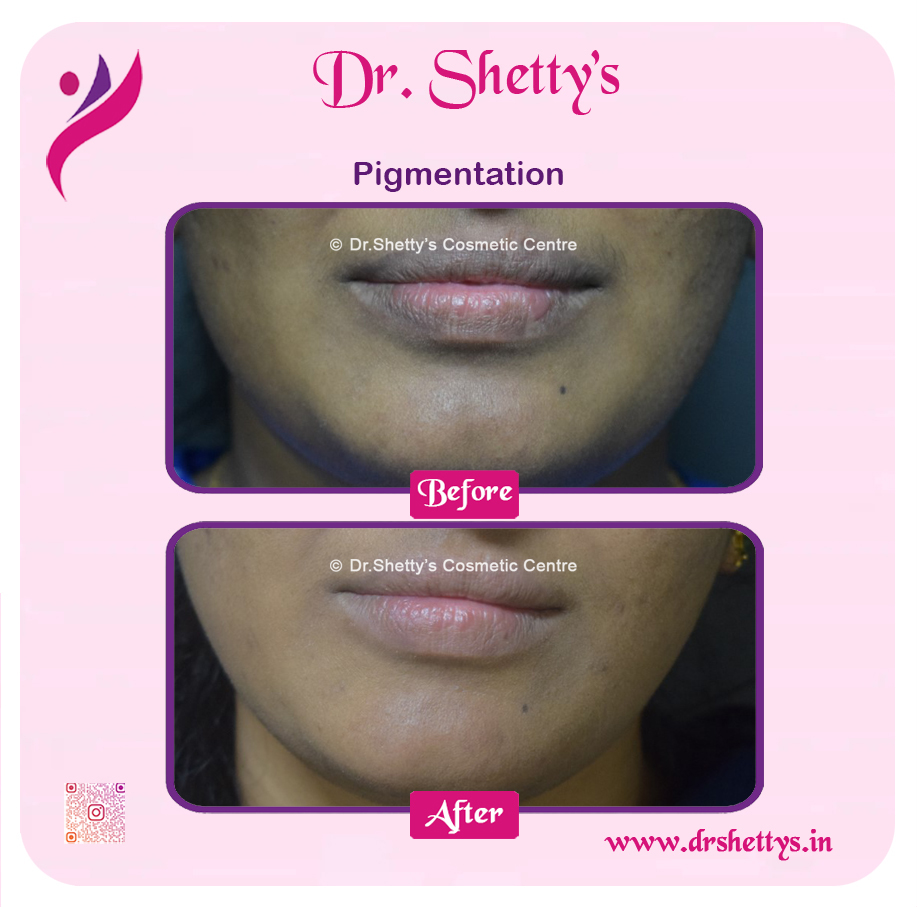 Lip Lightening Treatment 15