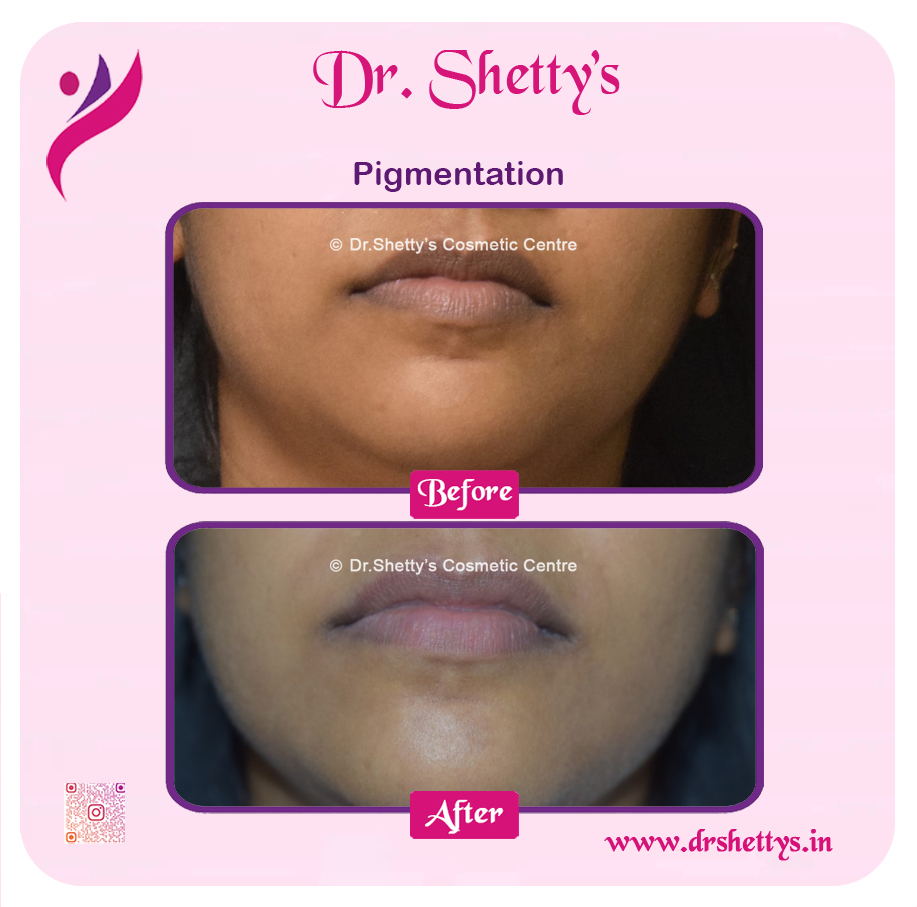 Lip Lightening Treatment 16