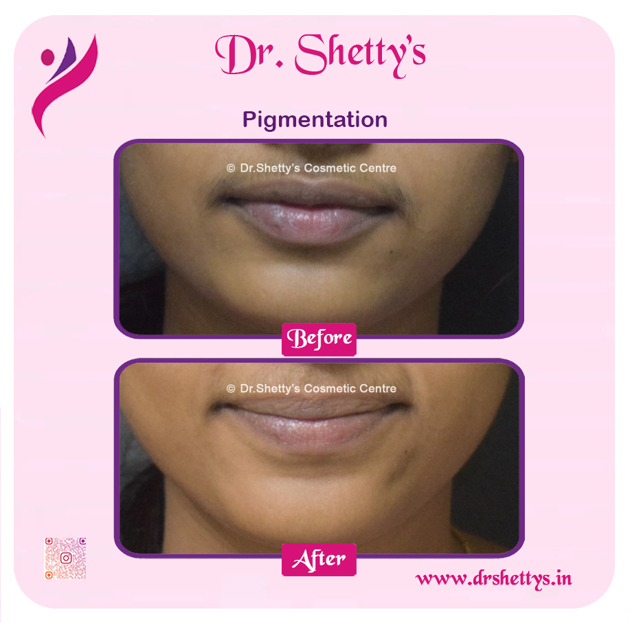 Lip Lightening Treatment 17