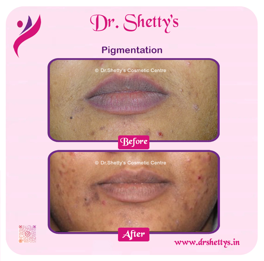 Lip Lightening Treatment 18