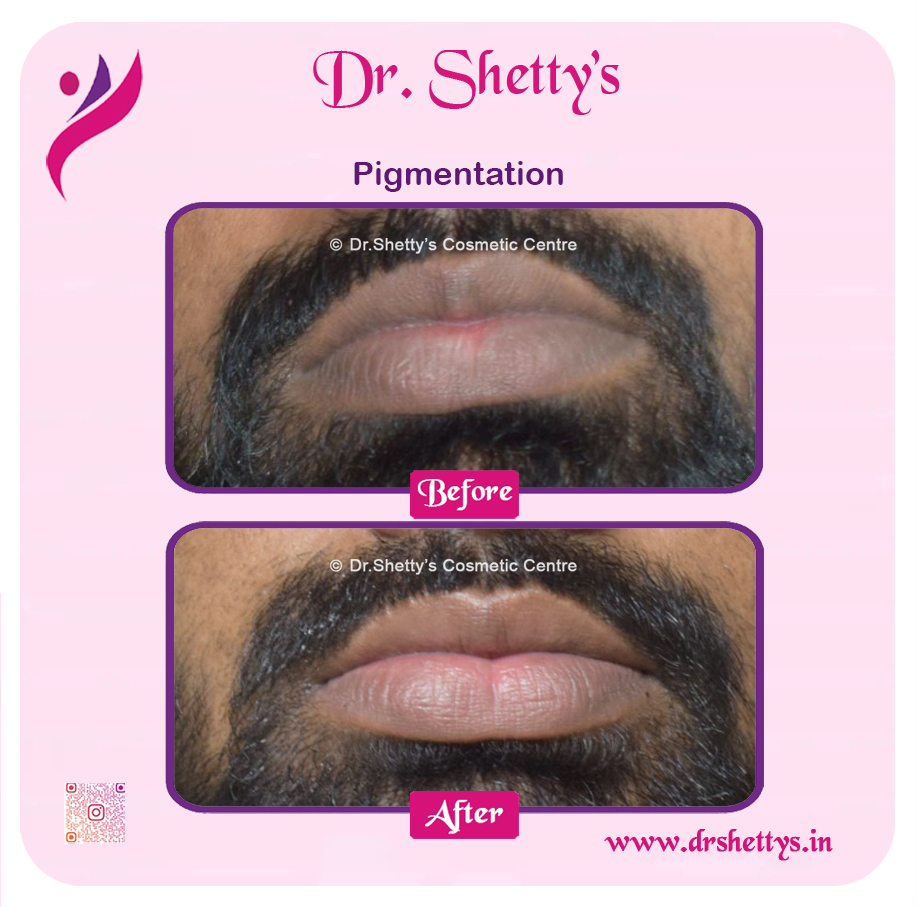 Lip Lightening Treatment 2