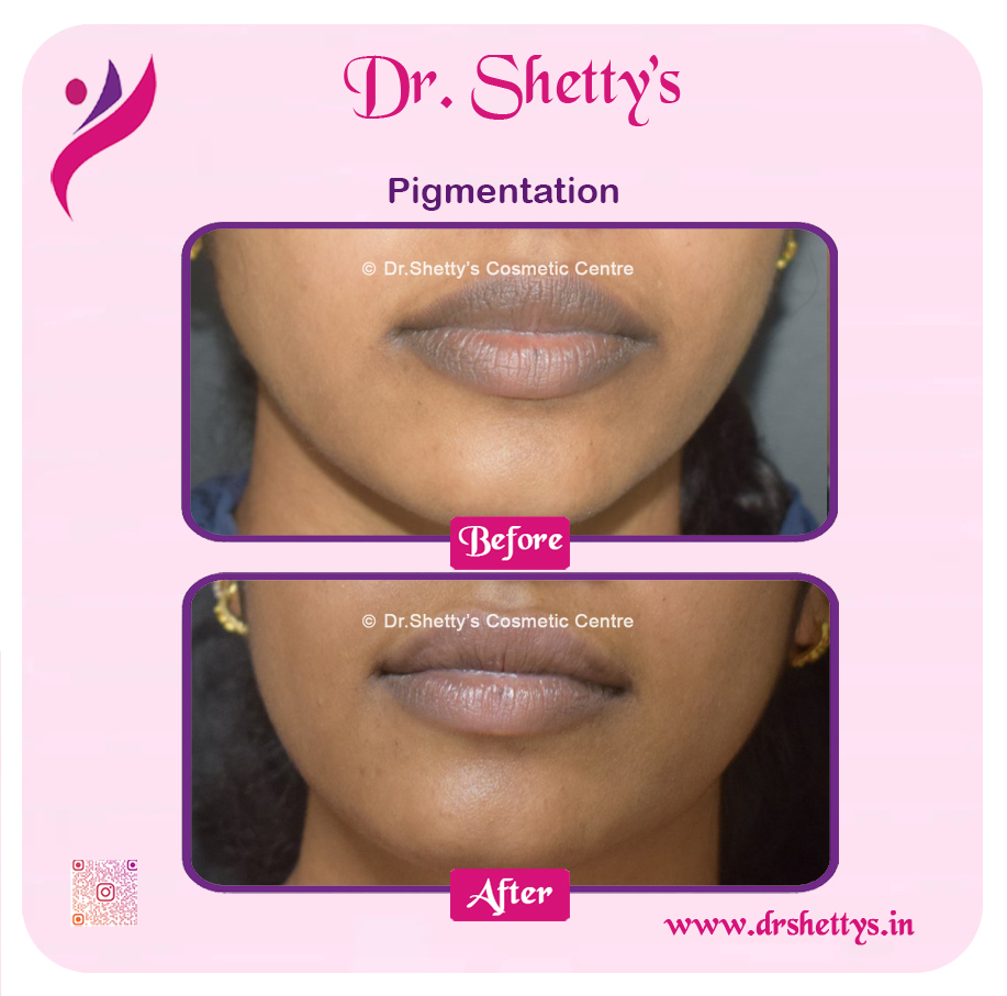 Lip Lightening Treatment 20