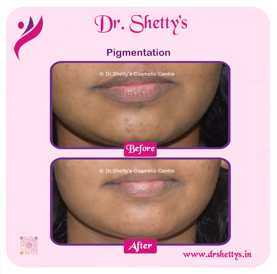 Lip Lightening Treatment 21