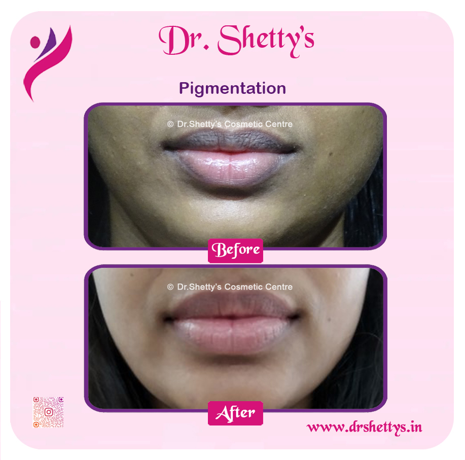 Lip Lightening Treatment 22