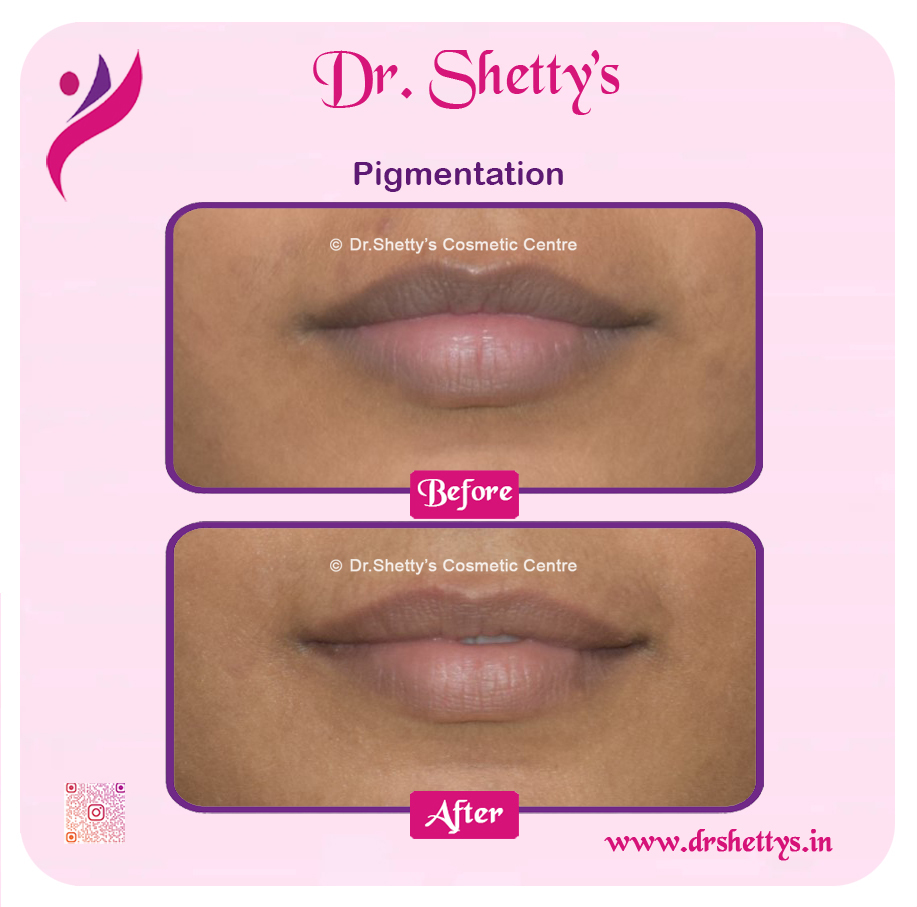 Lip Lightening Treatment 3