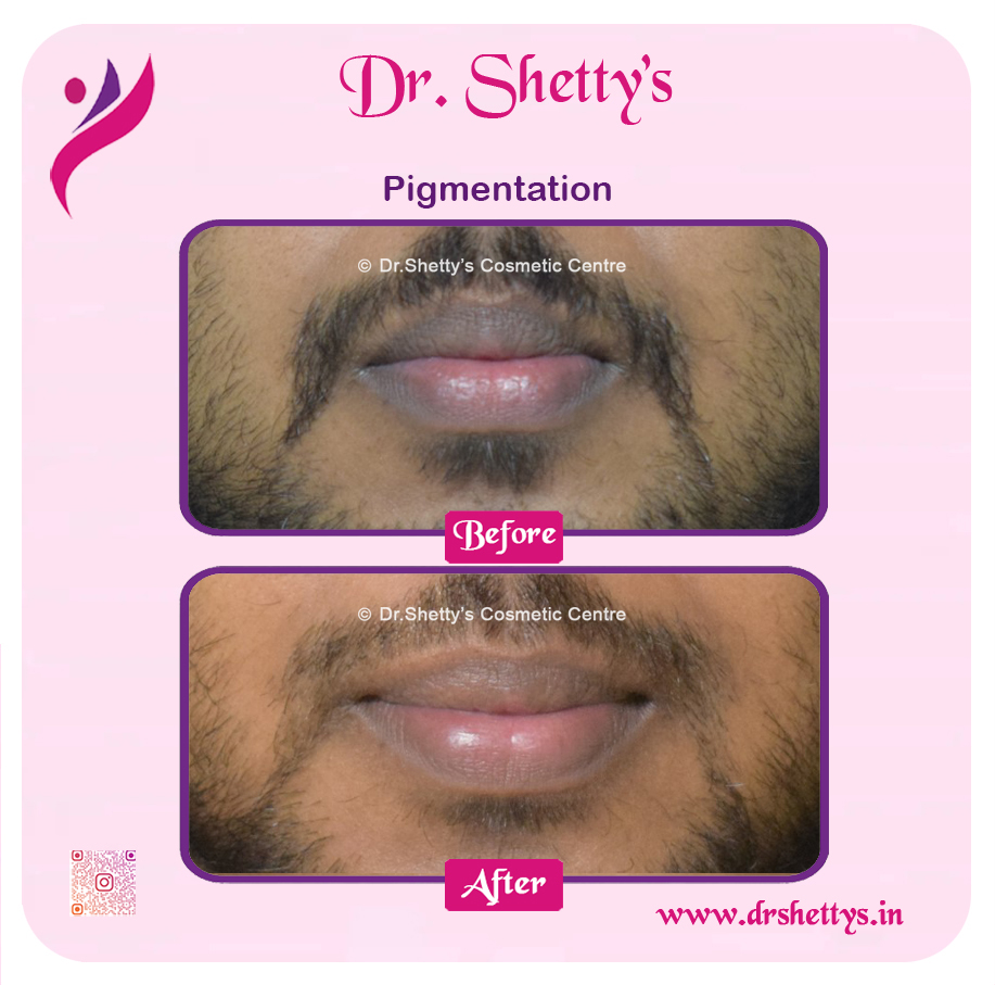 Lip Lightening Treatment 5