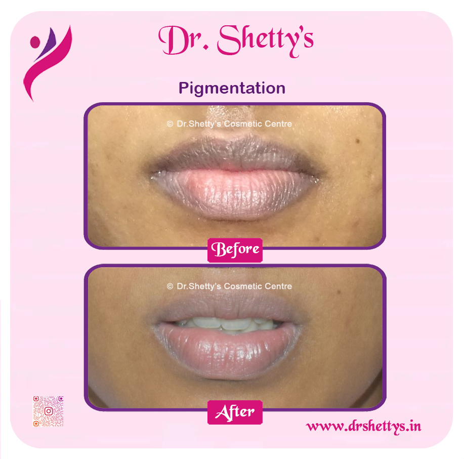 Lip Lightening Treatment 6