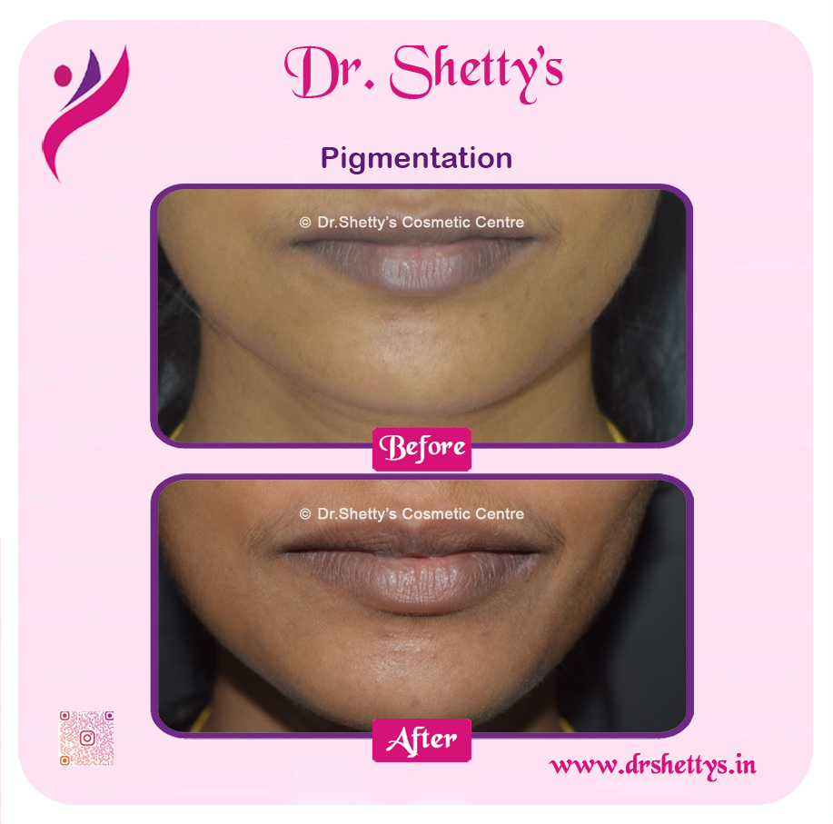 Lip Lightening Treatment 7