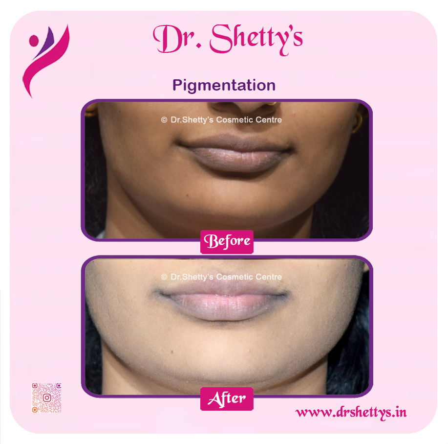 Lip Lightening Treatment 8