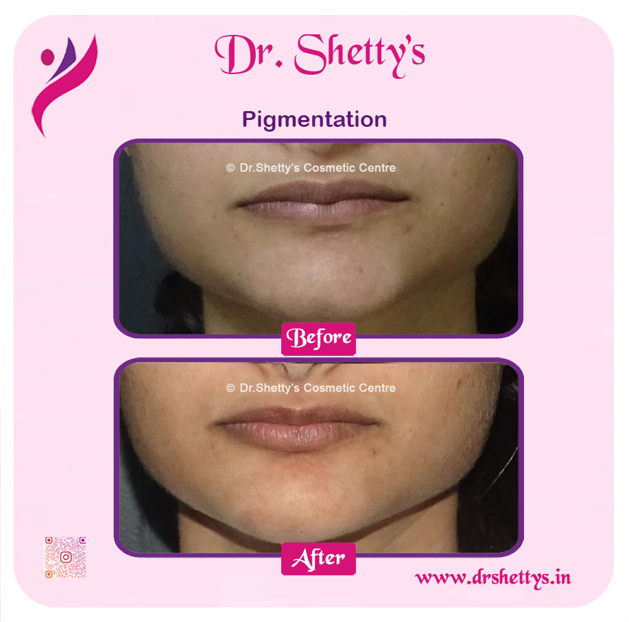 Lip Lightening Treatment 9