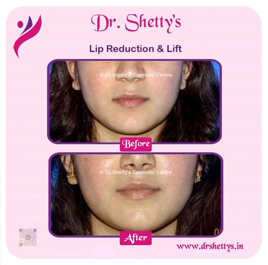 Lip Reshaping | Lip Augmentation | Lip Reduction in Bangalore