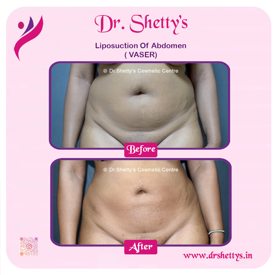 Liposuction 1