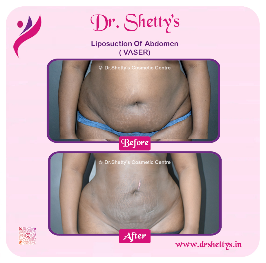 Liposuction 10