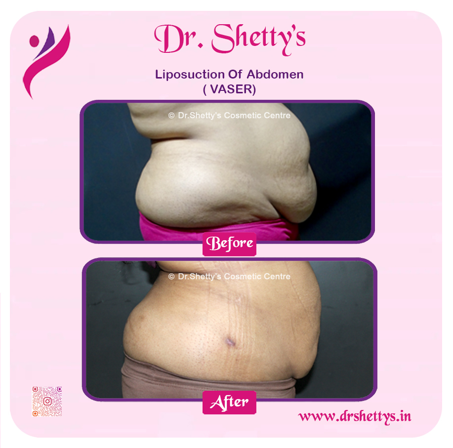 Liposuction 11