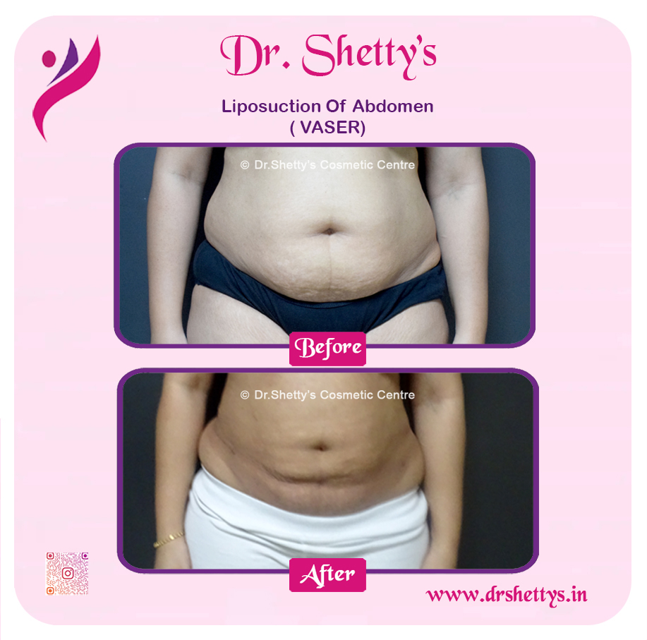 Liposuction 12