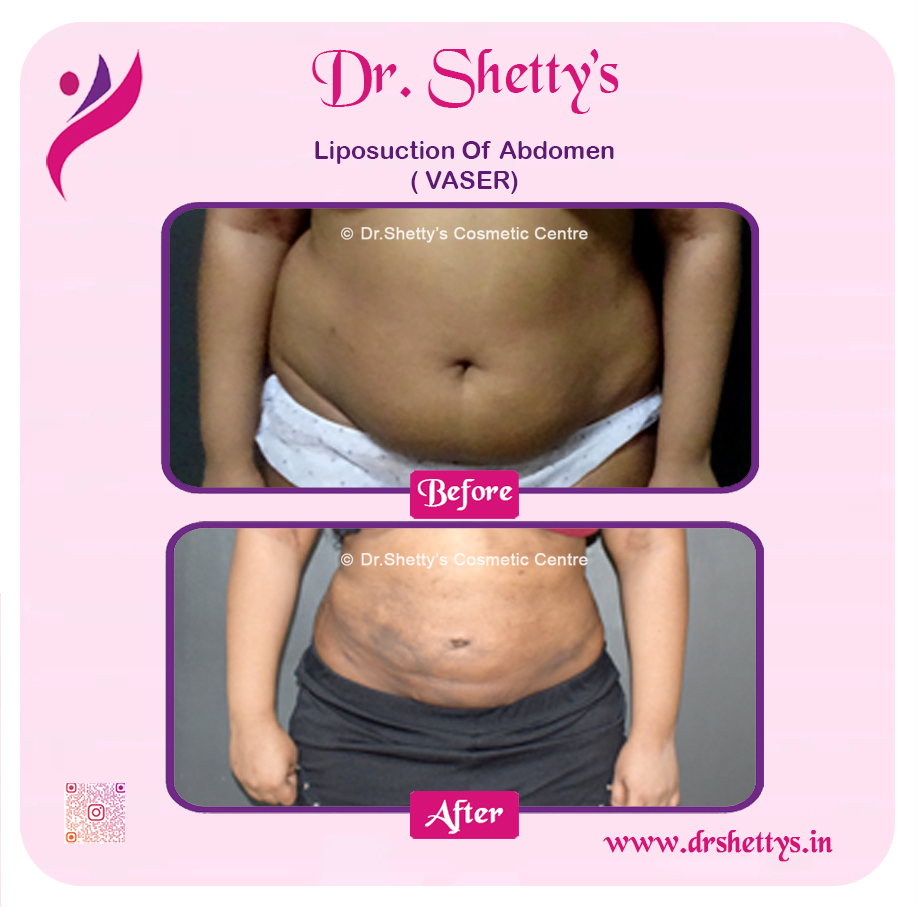 Liposuction 13