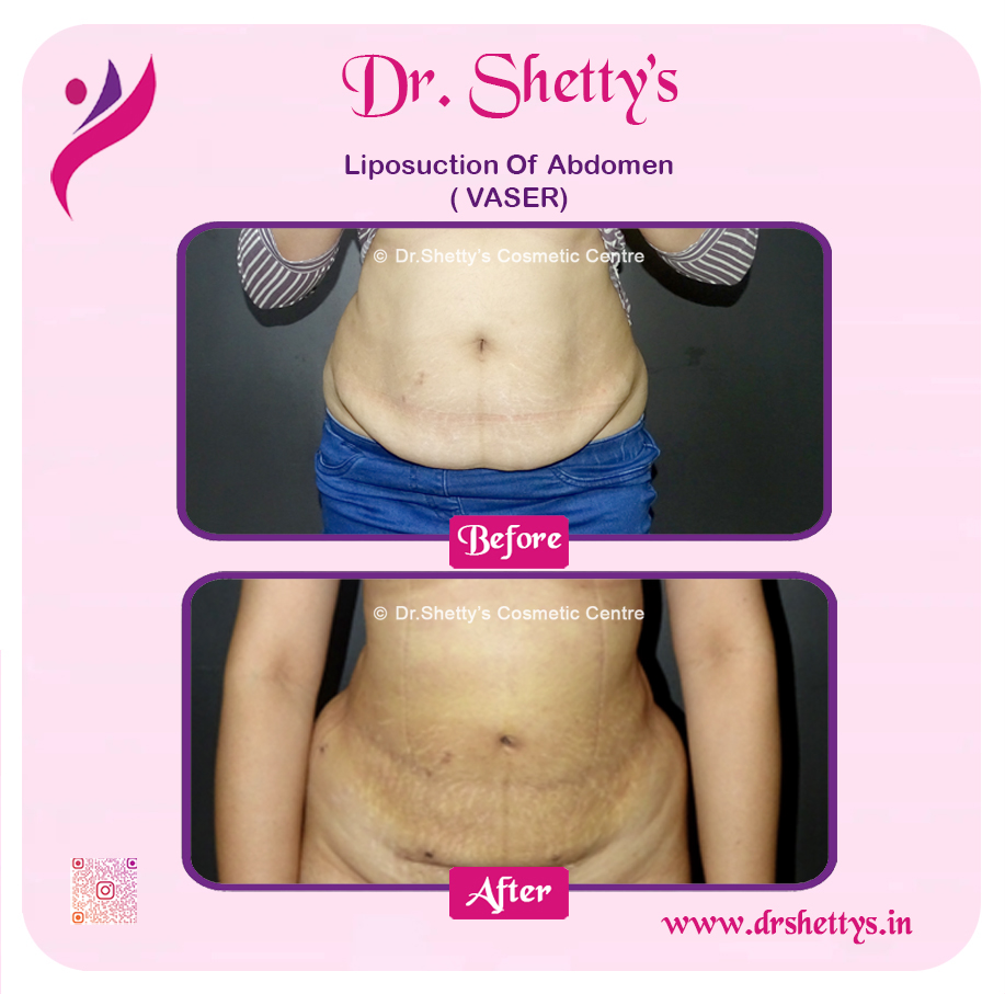 Liposuction 15