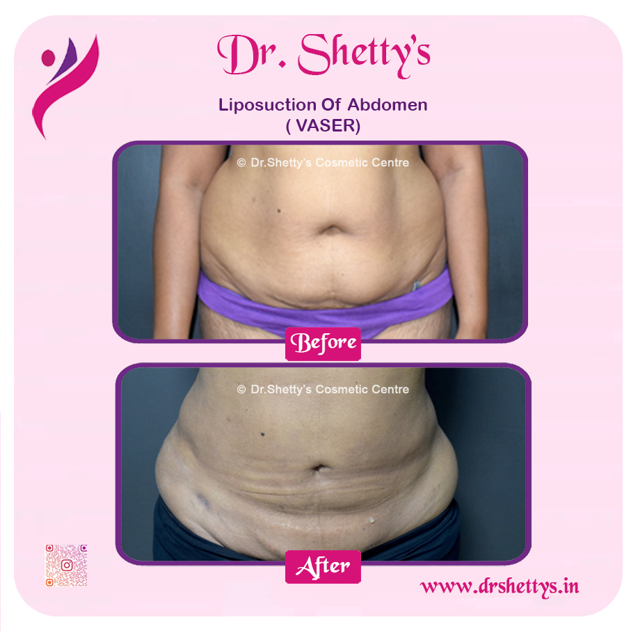Liposuction 17