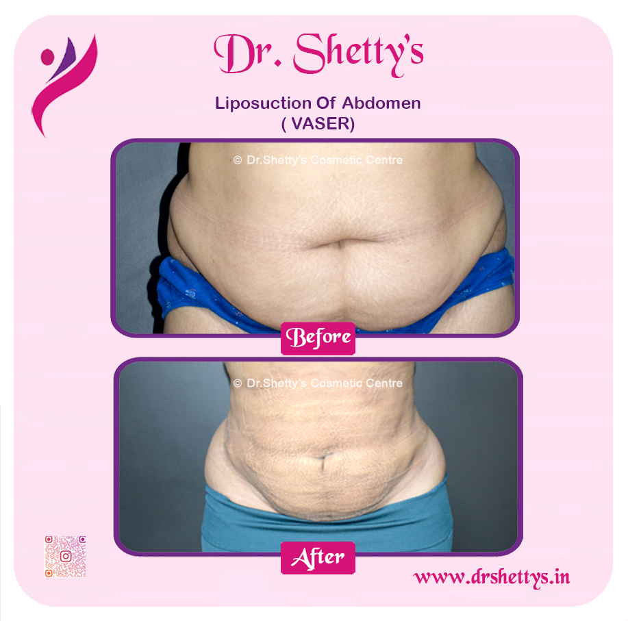 Liposuction 18