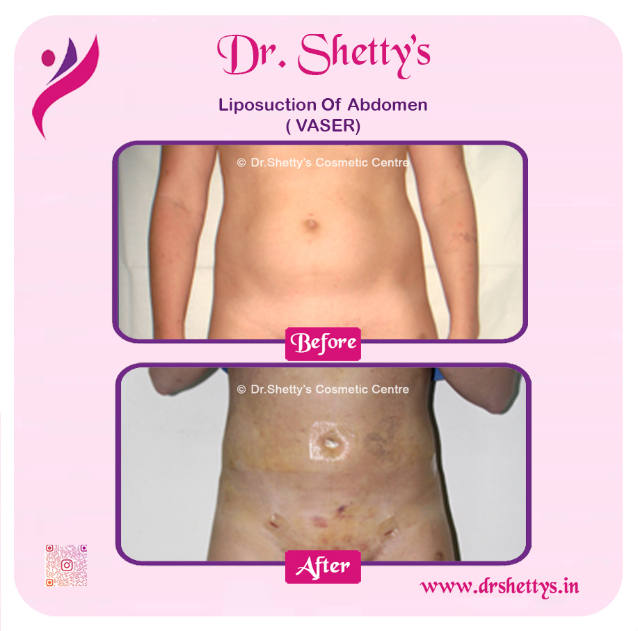 Liposuction 19