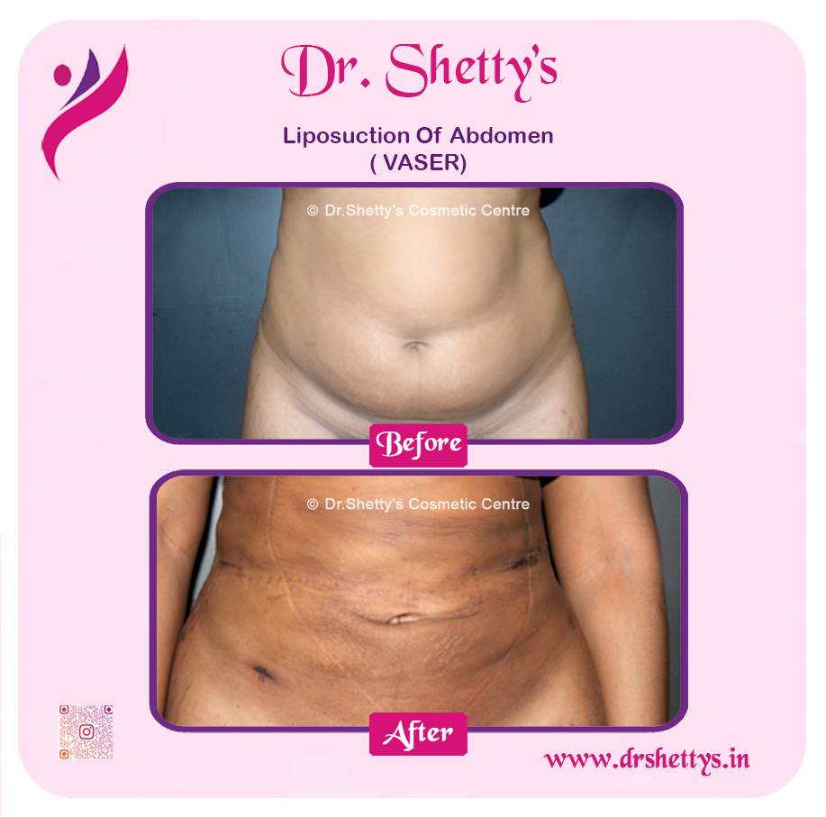 Liposuction 2