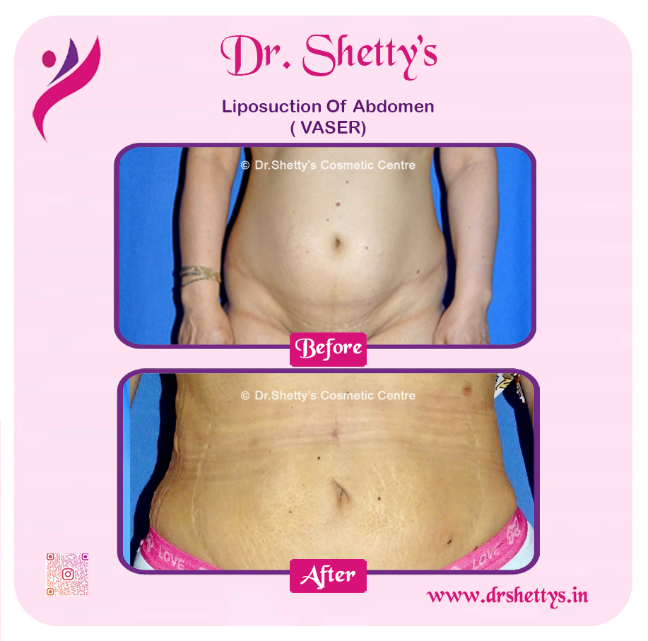 Liposuction 21