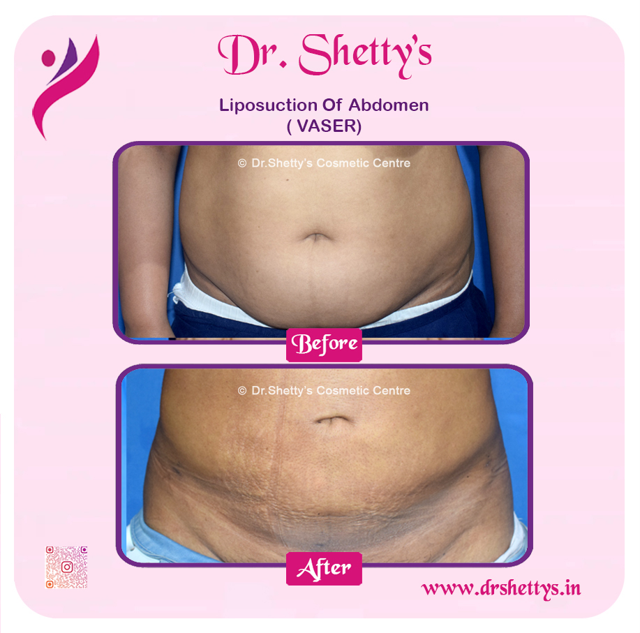 Liposuction 22