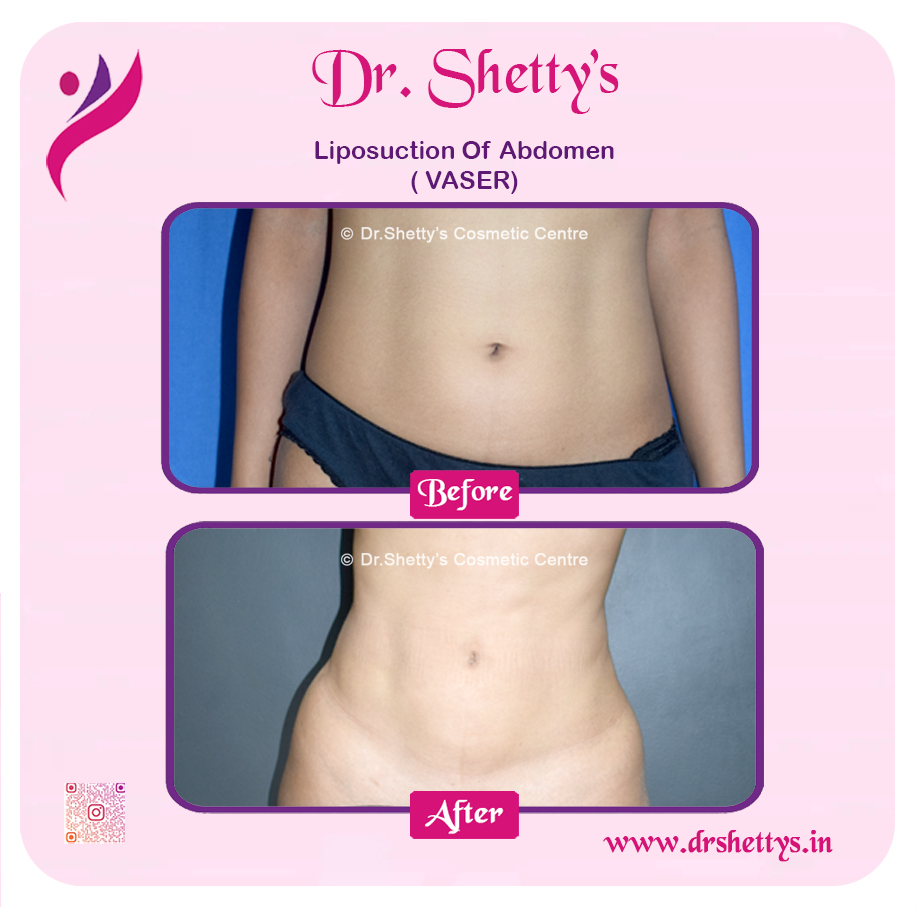 Liposuction 23