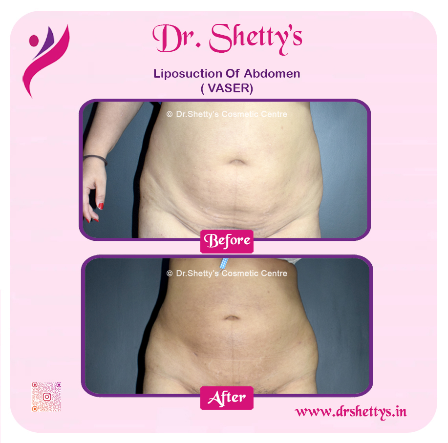 Liposuction 24