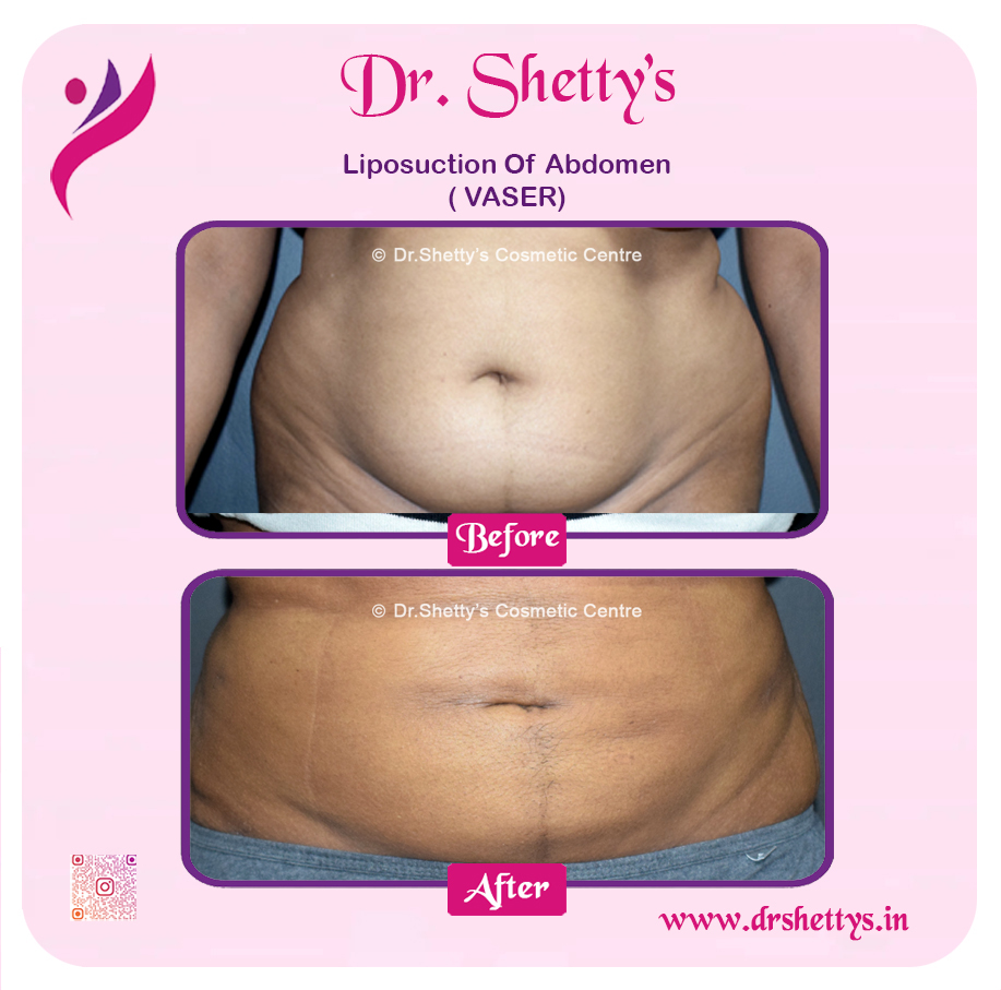 Liposuction 25