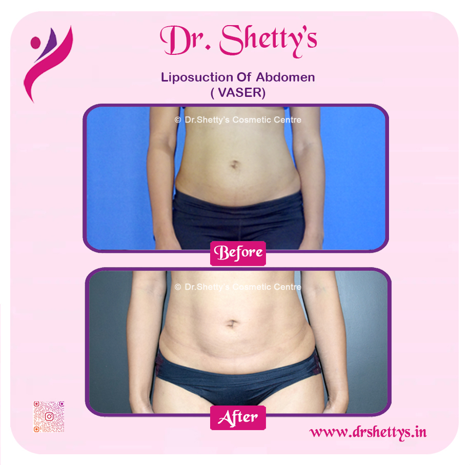 Liposuction 26