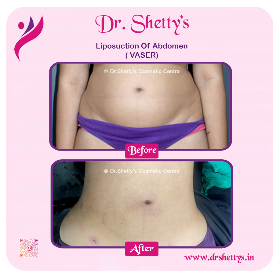 Liposuction 28