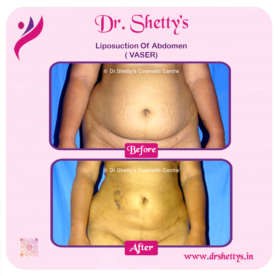 Liposuction 29