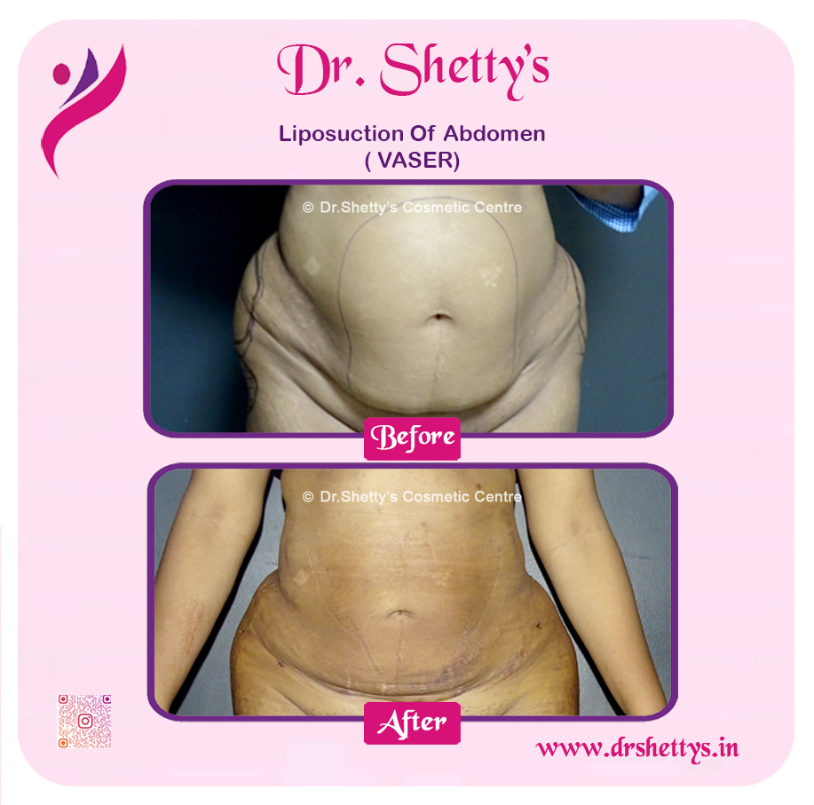 Liposuction 3