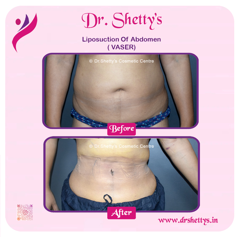 Liposuction 31