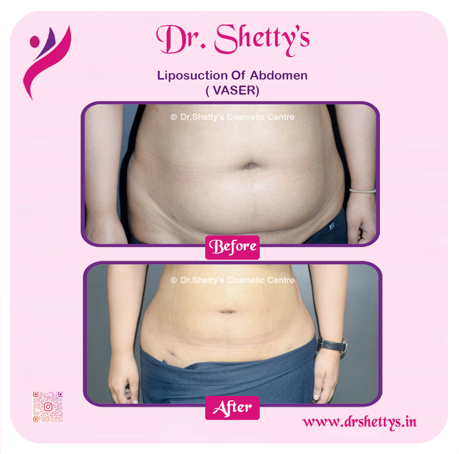 Liposuction 32
