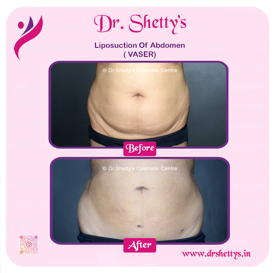 Liposuction 34