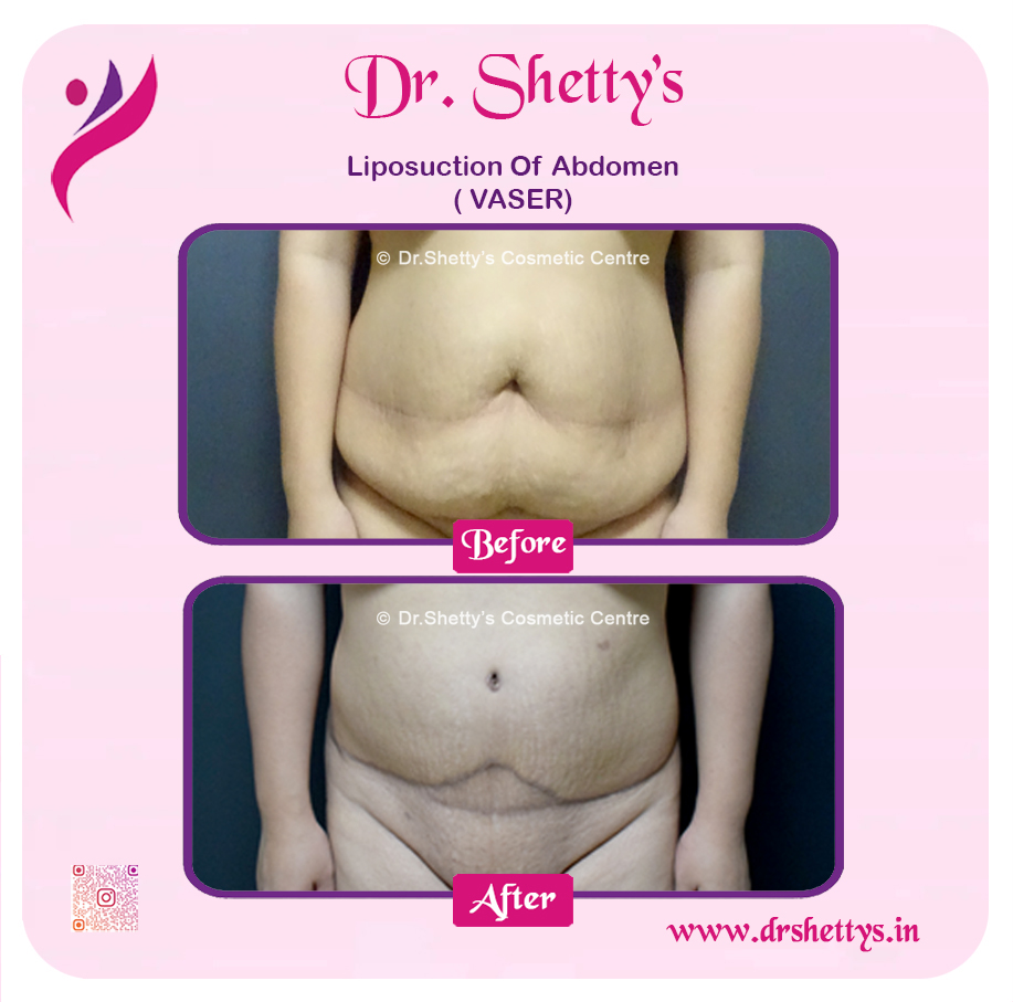 Liposuction 35