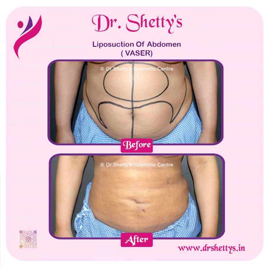 Liposuction 37
