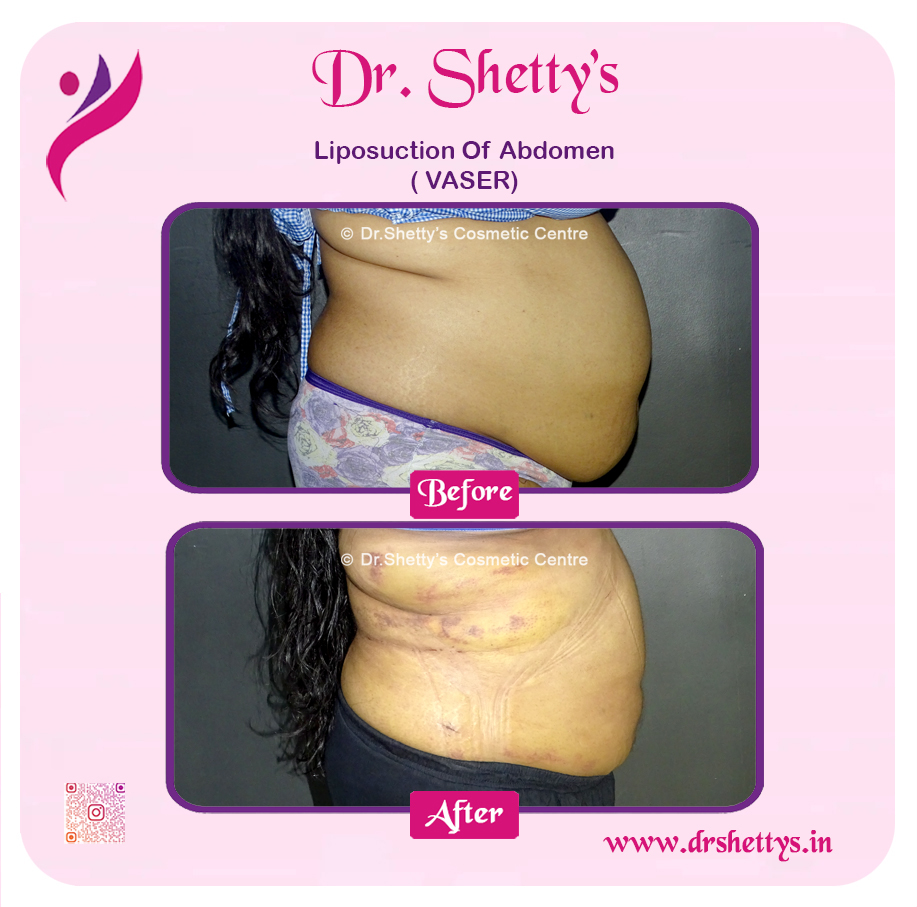 Liposuction 38