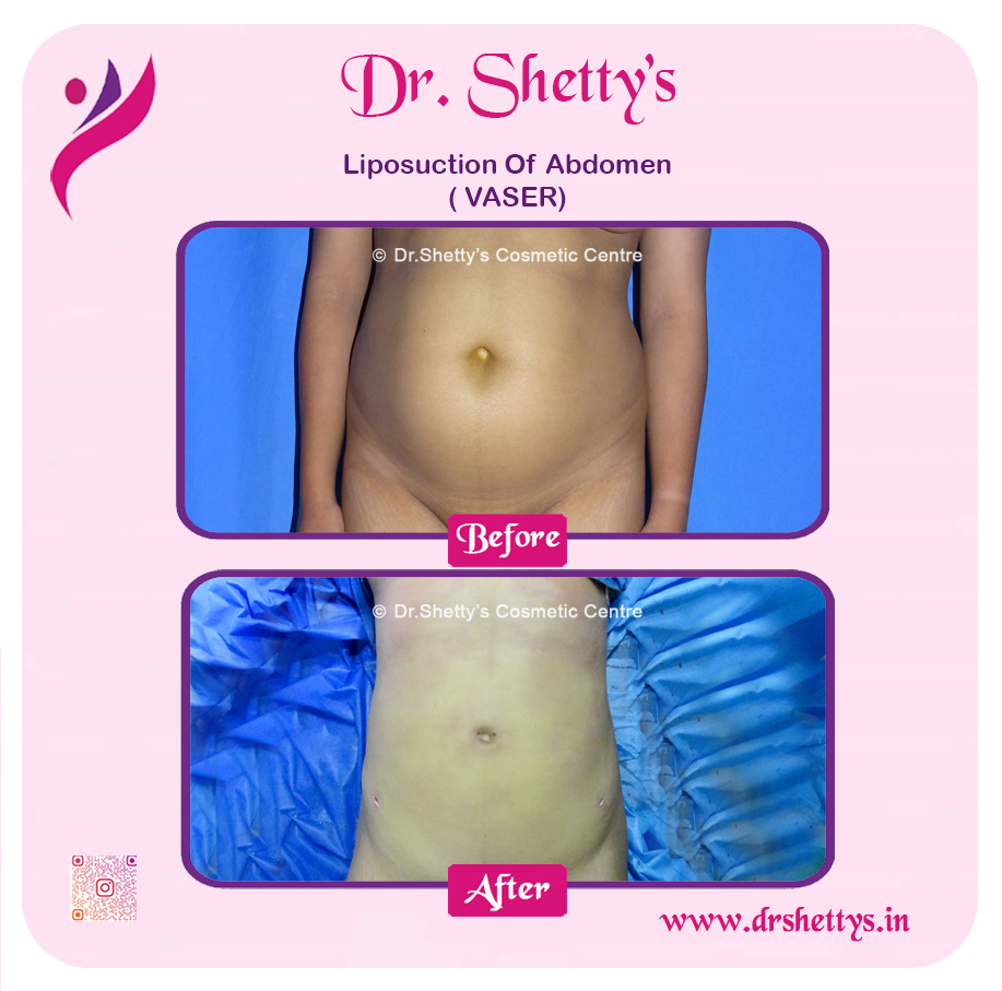 Liposuction 39