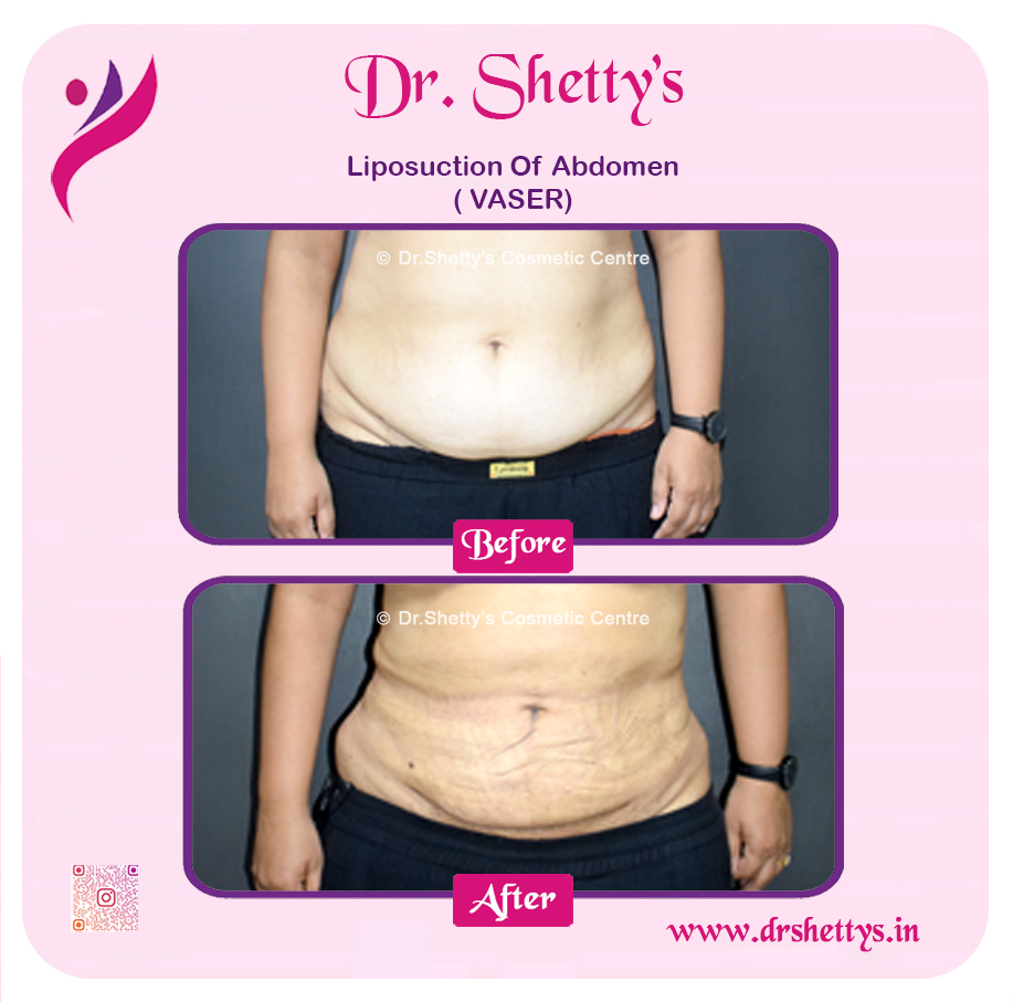 Liposuction 4