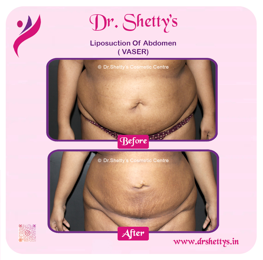 Liposuction 40