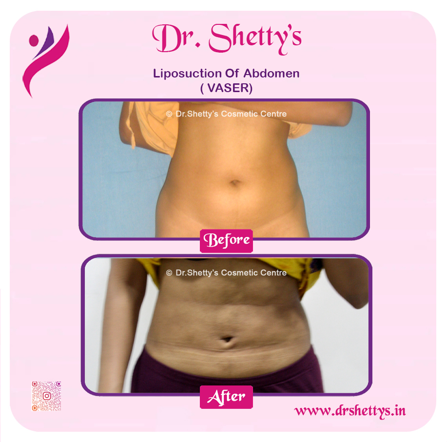 Liposuction 41