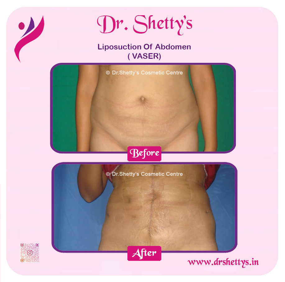 Liposuction 42