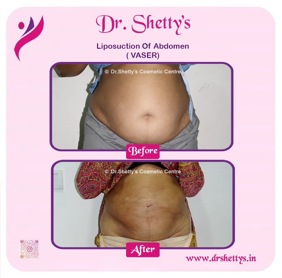Liposuction 43