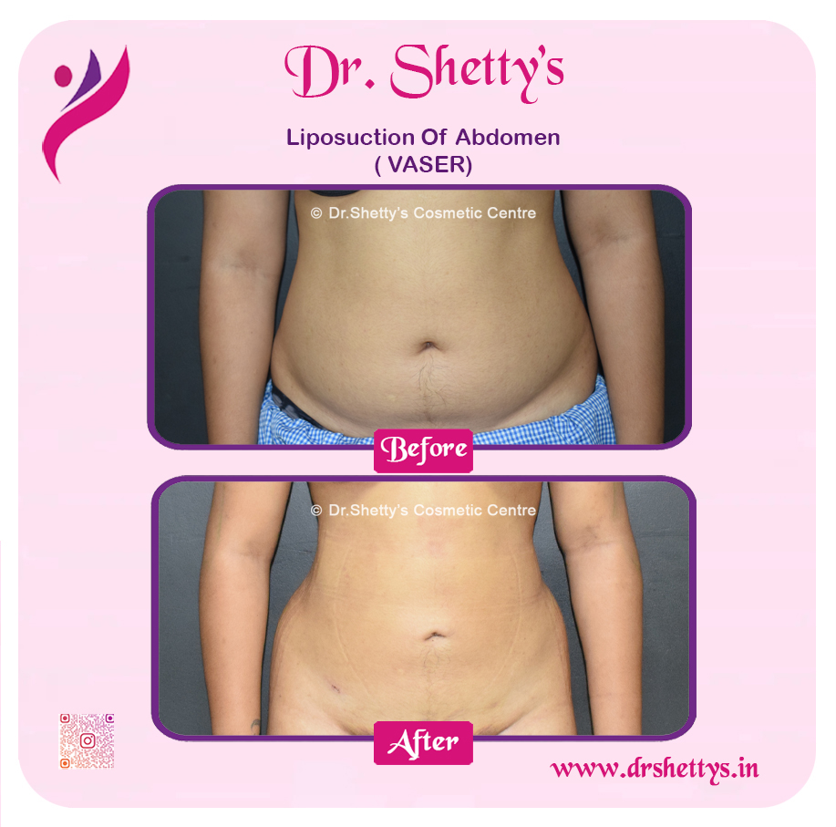 Liposuction 44